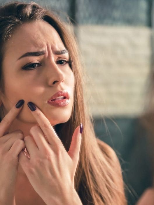 Perché l’acne può minare l’autostima e come conviverci serenamente